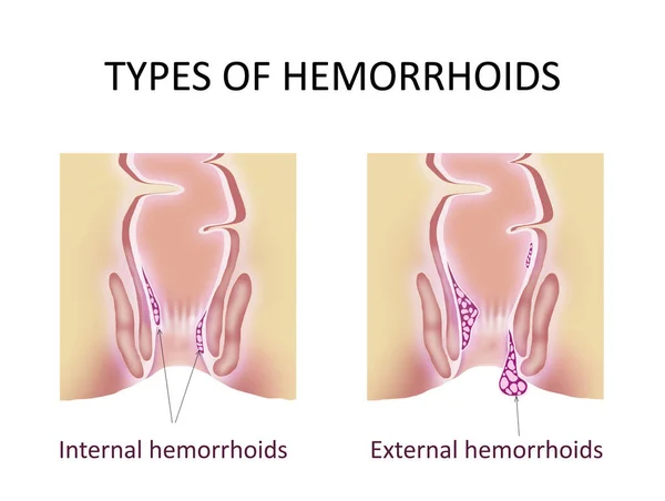 Tipos Hemorroides Recto Inferior Malsano Con Estructuras Vasculares Inflamadas Ilustración —  Fotos de Stock