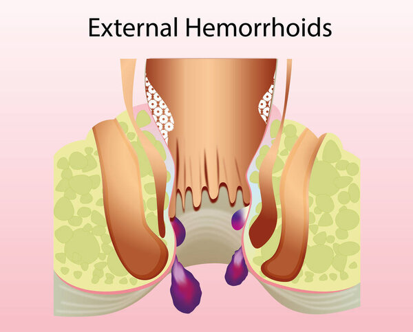 External hemorrhoid. Unhealthy lower rectum with inflamed vascular structures, illustration