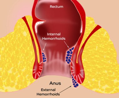 Hemorrhoid. Illustration of unhealthy lower rectum with inflamed vascular structures clipart
