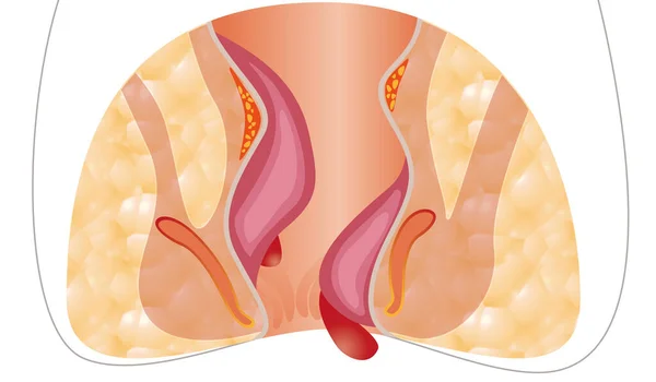 Hemoroidy Niezdrowy Dolny Odbytnica Zapalnymi Strukturami Naczyniowymi Ilustracja — Zdjęcie stockowe
