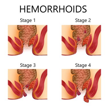 Hemoroit aşamaları. İltihaplı vasküler yapıları ve illüstrasyonu olan sağlıksız alt rektum