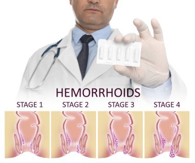 Doktor hemoroit tedavisi için fitiller tutuyor rektum hastalığının illüstrasyonundan dolayı.