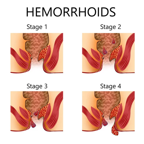 Etapas Hemorroides Recto Inferior Malsano Con Estructuras Vasculares Inflamadas Ilustración —  Fotos de Stock