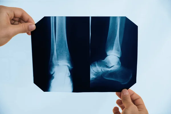 Ортопед Який Вивчає Рентгенівське Зображення Екрані Перегляду Крупним Планом — стокове фото