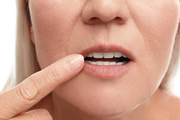 Wanita Dengan Sakit Dingin Menerapkan Krim Bibir Terhadap Latar Belakang — Stok Foto