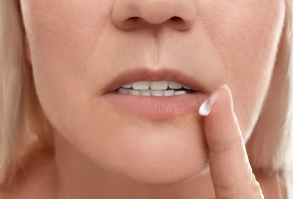 Wanita Dengan Sakit Dingin Menerapkan Krim Bibir Closeup — Stok Foto