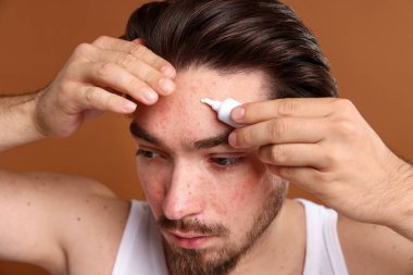 Sivilceli genç adam yüzüne krem sürerken kahverengi arka planda, yakın plan