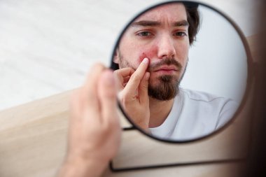 Akne sorunu olan genç bir adam içerideki masaya aynaya bakıyor.