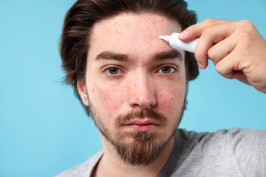 Sivilceli genç adam yüzüne krem sürerken açık mavi arka planda, yakın plan