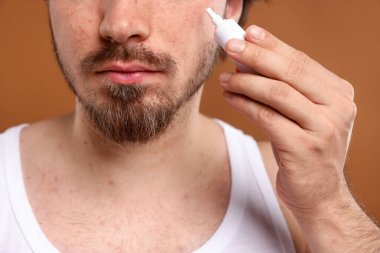 Sivilceli genç adam yüzüne krem sürerken kahverengi arka planda, yakın plan