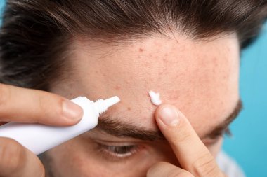 Sivilceli genç adam yüzüne krem sürerken açık mavi arka planda, yakın plan