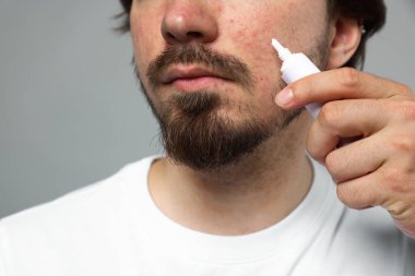 Sivilceli genç adam yüzüne krem sürerken açık gri arka planda, yakın plan