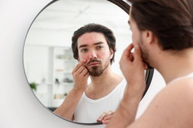 Evinde aynanın yanında sivilce sorunu olan genç bir adam var.