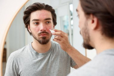 Evinde aynanın yanında yüzüne krem sürmekte zorlanan genç bir adam.