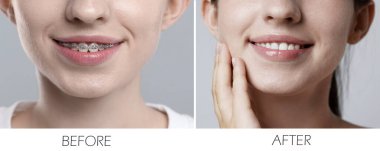 Diş teli kullanırken ve kullandıktan sonra dişlerini gösteren kadın, yakın plan. Gri arkaplanda fotoğrafların kolajı