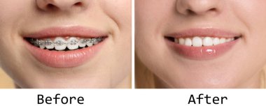 Diş teli kullanırken ve kullandıktan sonra dişlerini gösteren kadın, yakın plan. Fotoğraf Kolajı