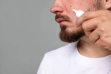 Açık gri arka planda yüzüne krem sürme sorunu olan genç bir adam, yakın plan. Metin için boşluk