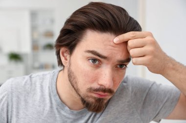 Evde akne sorunu olan genç bir adam, yakın plan.