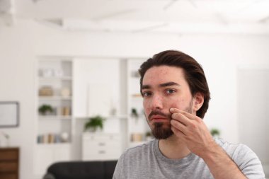 Evde akne sorunu olan genç bir adam. Metin için boşluk