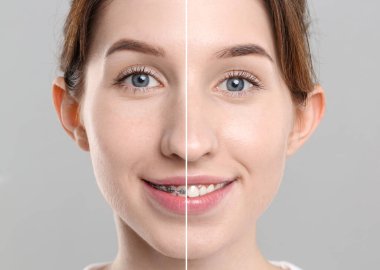 Dişleri düzeltmek için diş telleri. Gri arka planda gülümseyen kadının öncesi ve sonrası fotoğrafı ile kolaj, yakın plan