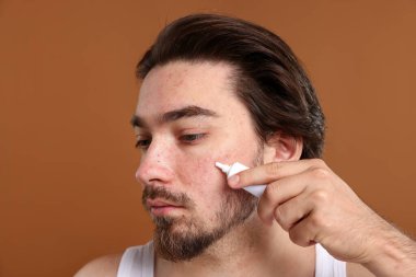 Sivilceli genç bir adam kahverengi arka planda yüzüne krem sürüyor.