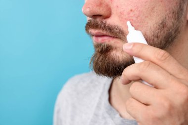 Sivilceli genç adam yüzüne krem sürerken açık mavi arka planda, yakın plan. Metin için boşluk