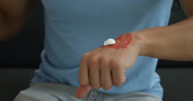 Evdeki yanık ele iyileştirme kremi süren adam, yakın plan.