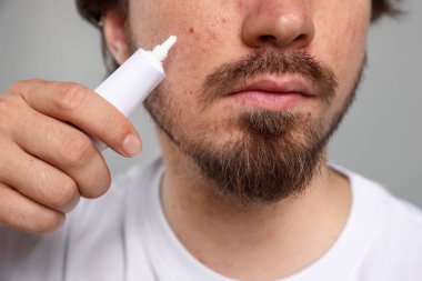 Sivilceli genç adam yüzüne krem sürerken açık gri arka planda, yakın plan