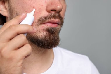 Sivilceli genç adam yüzüne krem sürerken açık gri arka planda, yakın plan