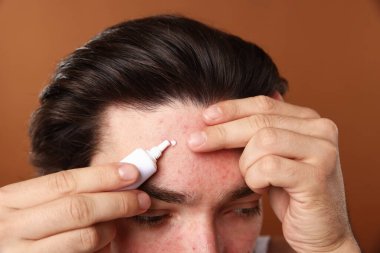 Sivilceli genç adam yüzüne krem sürerken kahverengi arka planda, yakın plan