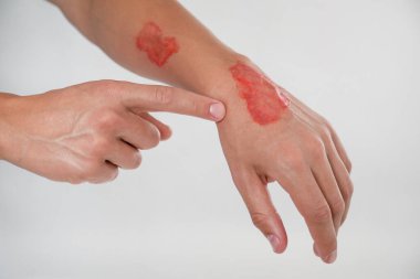 Açık gri arka planda yanmış eli olan adam, yakın plan.