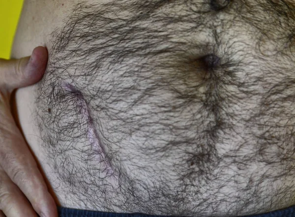 Homem caucasiano mostra sua cicatriz devido a cirurgia de remoção — Fotografia de Stock