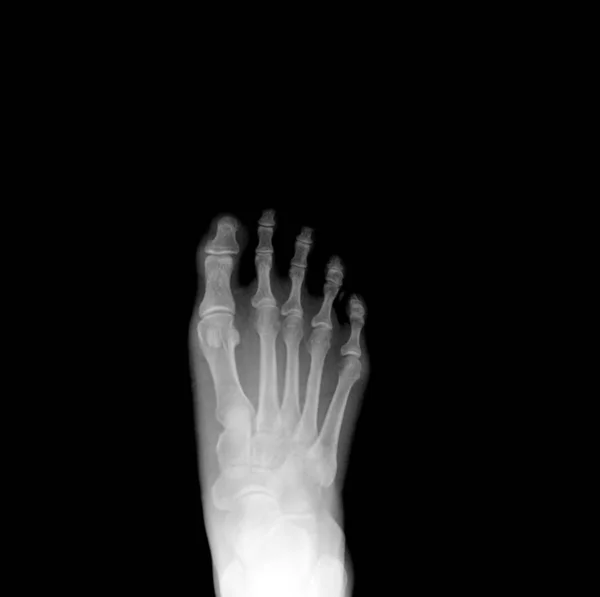 Ακτινογραφία Του Δεξί Πόδι Ream Pain Στο Πόδι — Φωτογραφία Αρχείου