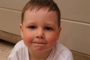 bir çocuk, bir çocuk alerji sıcaklık kırmızı yanakları portresi. Çocuk sıcaklığında, çocuğun alerjik reaksiyon yok. Çocuk kırmızı yanakları sıcaklığından vardır. çocuk alerji ateş üzerinden kırmızı yanakları sahiptir.