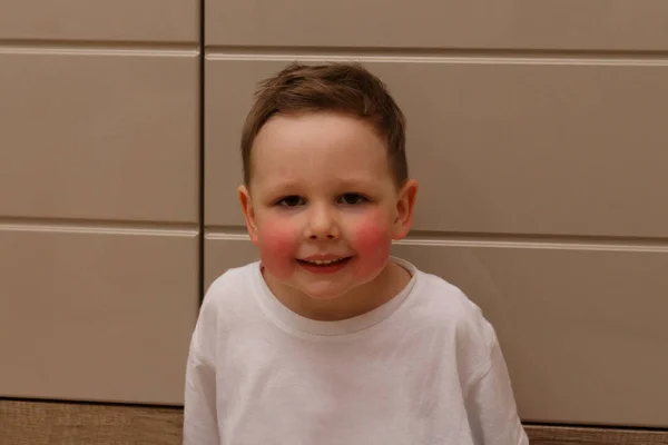 Portré Egy Gyermek Egy Fiú Hőmérséklet Allergiától Vörös Arccal Hőmérséklet — Stock Fotó