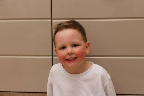 Boy Has Red Cheeks Rash His Cheeks Child Rash His — Stock Photo, Image