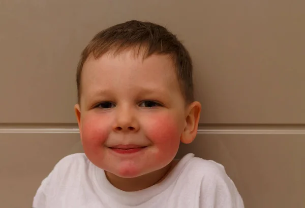 Boy Has Red Cheeks Rash His Cheeks Child Rash His — Stock Photo, Image