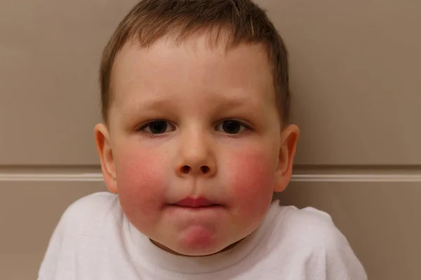 Boy Has Red Cheeks Rash His Cheeks Child Rash His — Stock Photo, Image