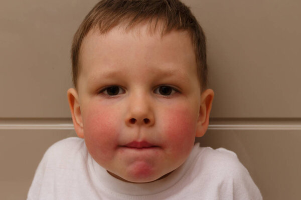the boy has red cheeks, a rash on his cheeks in the child, a rash on his cheeks from allergies, an allergic reaction to food, citrus. an allergy to medicines. child with allergies. red cheeks in the boy, in a white T-shirt, antihistamines.atopic derm