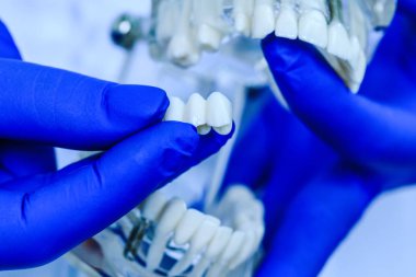Doktor elleri diş kliniğinde diş modelini tutuyor. Mavi eldivenli gerçek bir dişçi tarafından tutulan diş modeli. Diş hekimi çene modeli gösteriyor. Diş sağlığı, diş bakımı, sağlıklı dişler, ortodontik ve hijyen konsepti.
