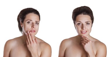 Before and after comparison picture of a beautiful young woman concerned about cold sore on her lips and smiling after treatment isolated on white backround clipart
