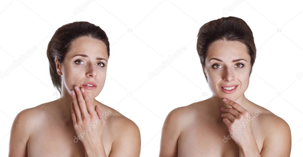 Before and after comparison picture of a beautiful young woman concerned about cold sore on her lips and smiling after treatment isolated on white backround