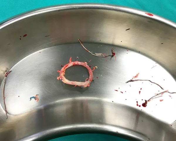 Inelul Mitral Anuloplastie Este Îndepărtat Din Cardiac După Poate Reduce — Fotografie, imagine de stoc
