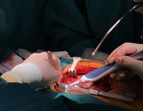 心脏胸外科医生通过多种工具离开乳腺内动脉进行无晶状体切除术 这种动脉连接到冠状动脉 以改善心脏的血液供应 — 图库照片
