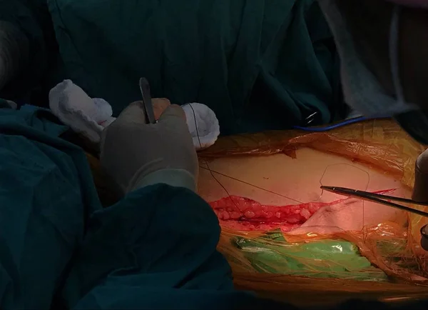 外科医生在得到连接到冠状动脉旁路的静脉后 正在缝合左腿的伤口 外科医生视图 — 图库照片