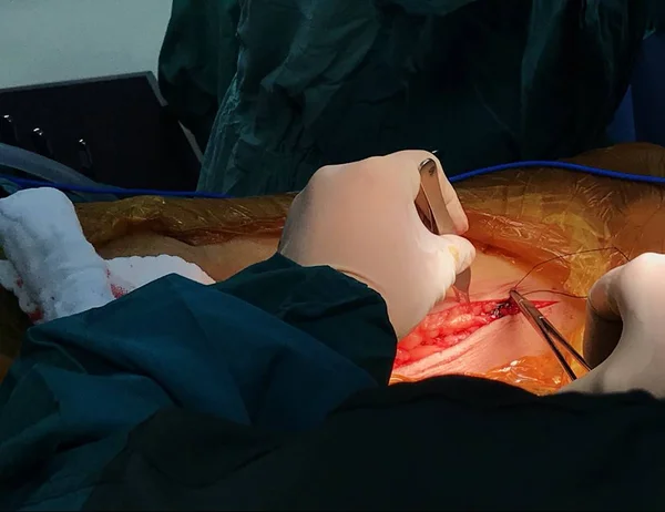 外科医生在得到连接到冠状动脉旁路的静脉后 正在缝合左腿的伤口 外科医生视图 图库照片