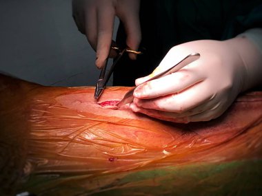 Bir doktor ven kullanımı bypass koroner arter cerrahisi için var vardı sonra scrub hemşire bacak deri dikiş. Resim merkezinde odaklanın.