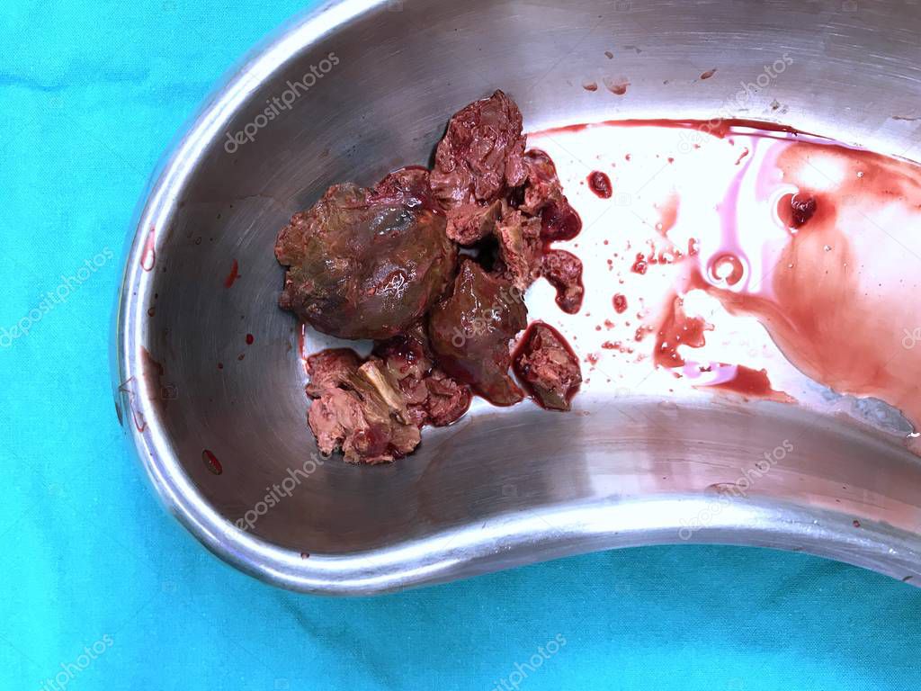 Many thrombus in blow had removed from hearts patient who was diagnosis valve stenosis during operate to correct heart valve.