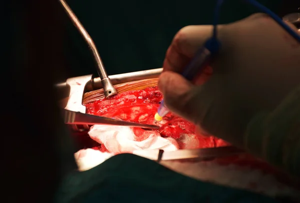 Yardımcıları alanı onun için takas ederken cerrah göğüs kemiğinin altında kanama durdurma.