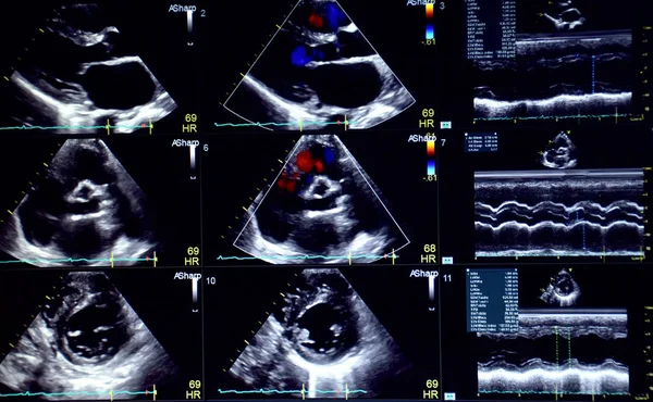 Las Imágenes Del Ecocardiograma Ultrasonido Haert — Foto de Stock